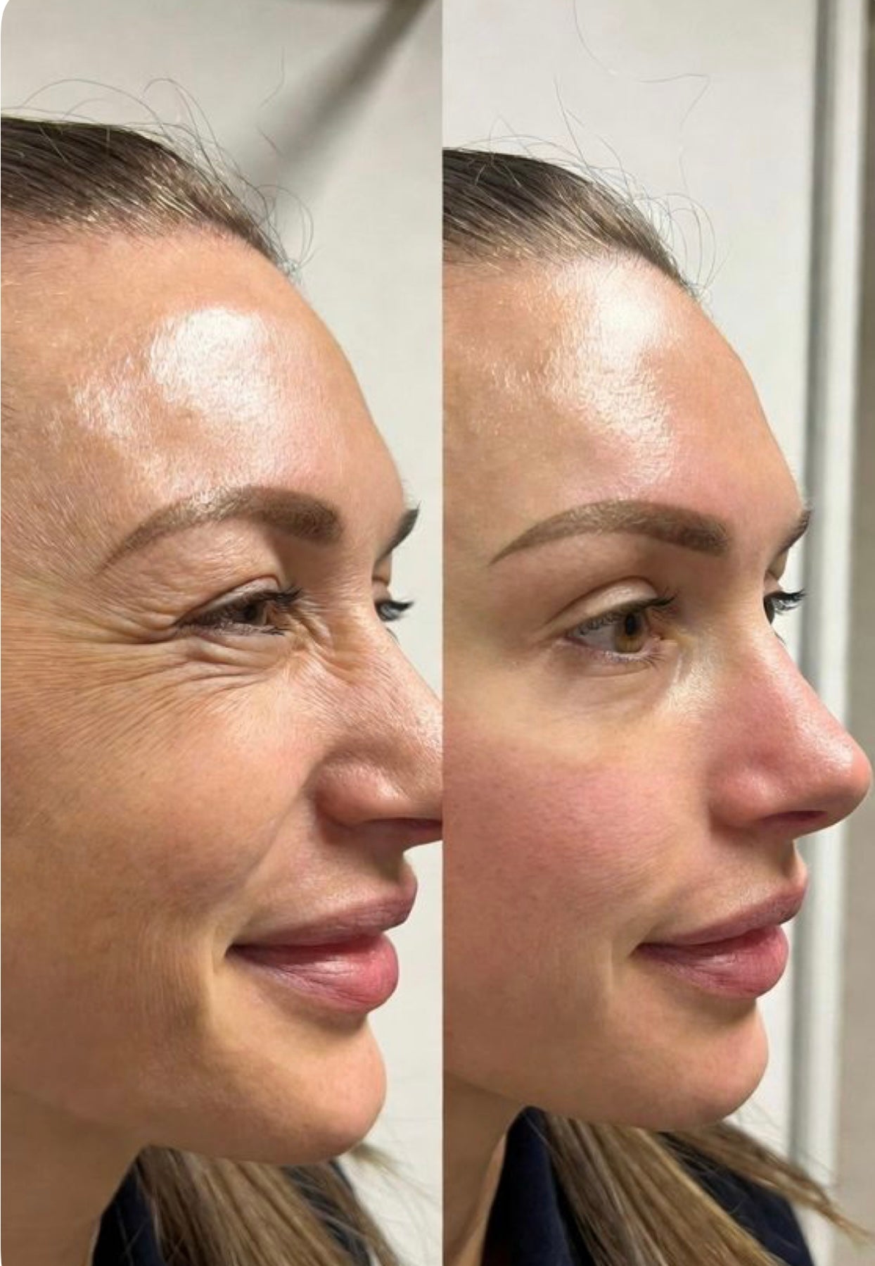 Allura Kollagen Masken  (Limited Edition)